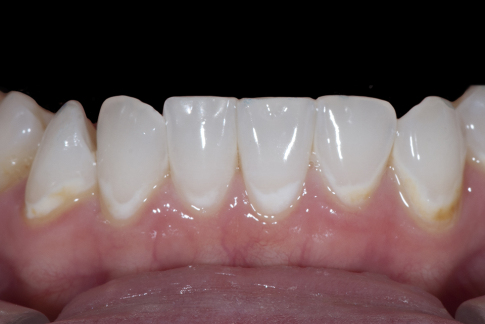 Noelle Instant Orthodontics X121L Post 9435
